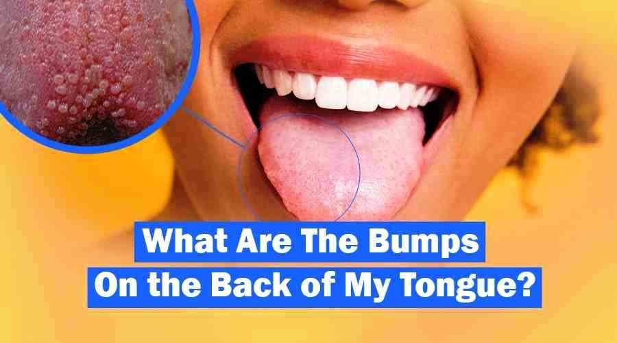 Tongue Bumps