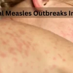 How Global Measles Outbreaks Impact USA