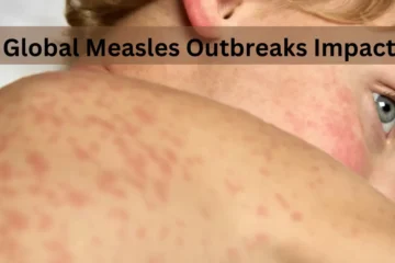 How Global Measles Outbreaks Impact USA