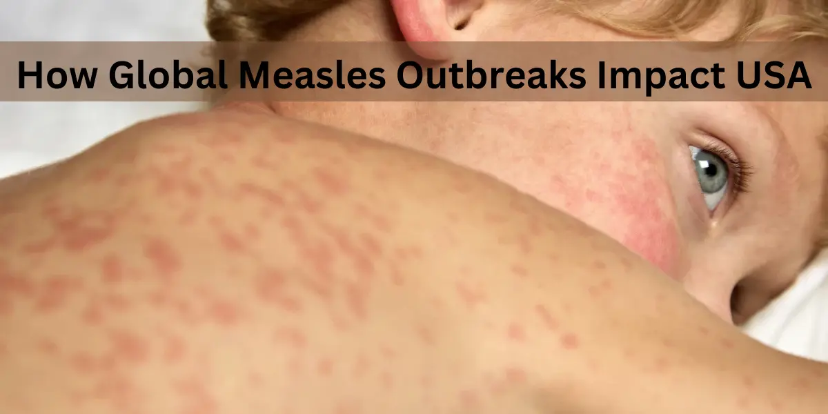 How Global Measles Outbreaks Impact USA